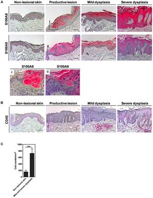 Chronic Inflammatory Microenvironment in Epidermodysplasia Verruciformis Skin Lesions: Role of the Synergism Between HPV8 E2 and C/EBPβ to Induce Pro-Inflammatory S100A8/A9 Proteins